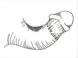 引起尿道上裂的病因是什么？